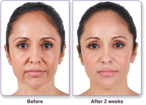 Side-by-side photos of a woman’s face: on the left labeled Before with more visible wrinkles, and on the right labeled After 2 weeks with smoother, more even skin.