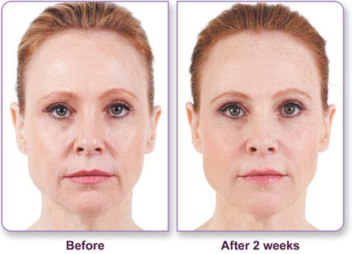 Side-by-side photos of a woman’s face showing a “Before” image with visible wrinkles and a neutral expression, and an “After 2 weeks” image with smoother skin and a slightly brighter complexion.
